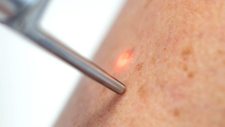 Taches pigmentaires sur la peau du visage