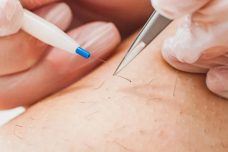 Gros plan sur une séance d'électrolyse : le microfilament est glissé le long du poil pendant que la pince retire le poil traité